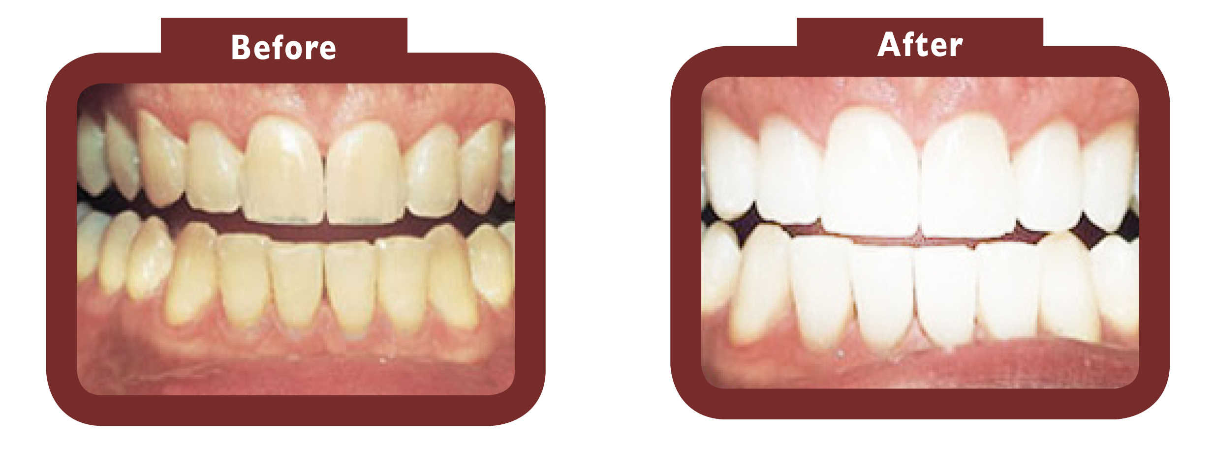 before and after teeth whitening - LA TEETH Hampshire