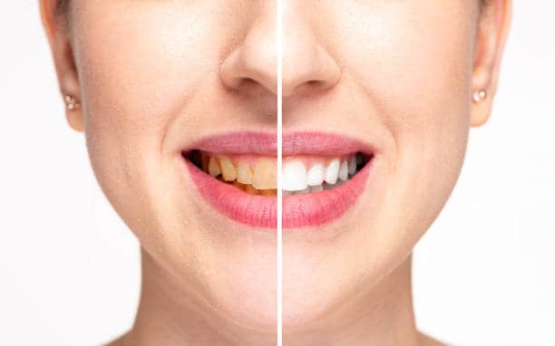 Teeth Whitening Milton Keynes Hampshire