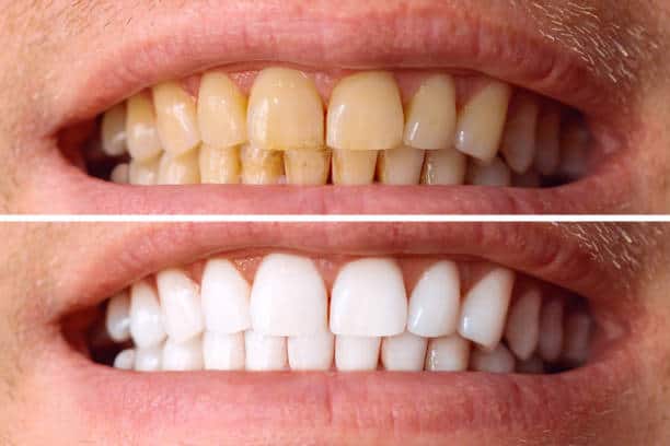 Laser White For Ever Bright – Get a Brighter, Whiter Smile with LA Teeth Whitening Hampshire