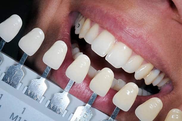 Get Natural and Stunning Smile with Teeth Whitening Results from LA Teeth Whitening Hampshire