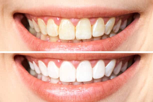 Achieve a Dazzling Smile for Your Special Day: A Guide to Wedding Teeth Whitening Hampshire