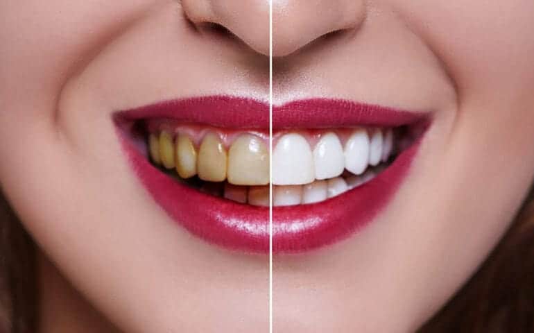 Teeth Whitening Ascot Windsor Hampshire