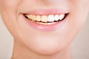 Can Whiter Teeth Make Them Look Straighter Hampshire