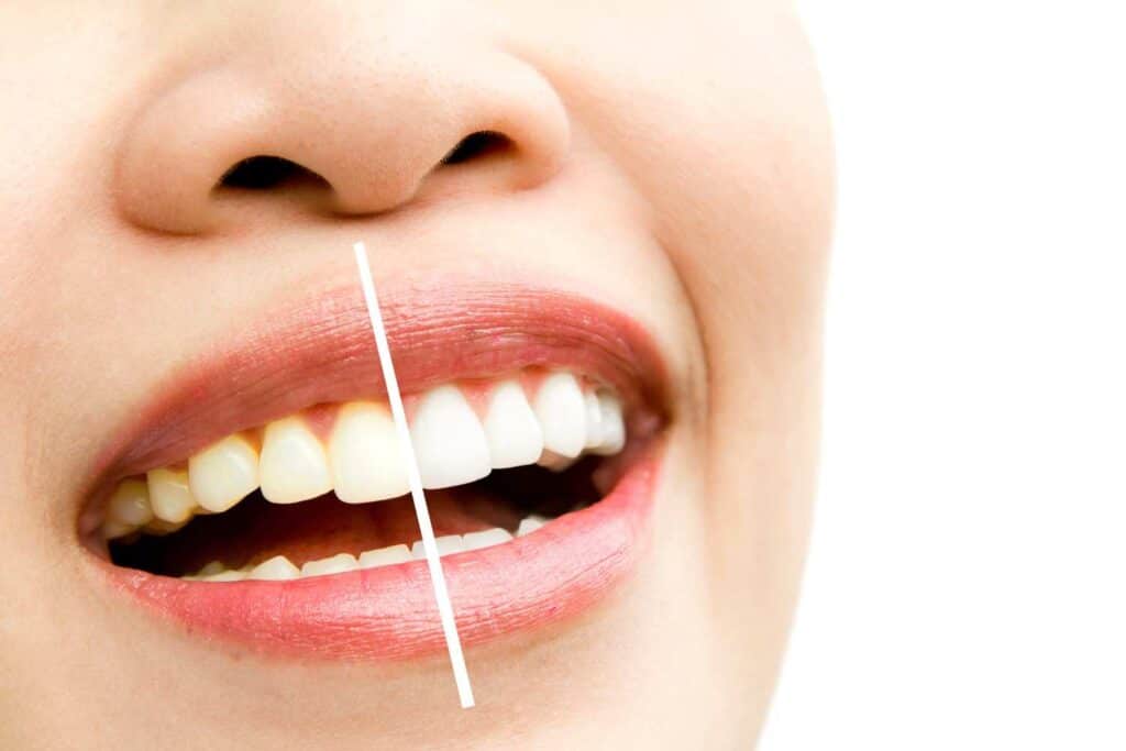 Can I Maintain My New Smile If I&rsquo;m a Coffee or Red Wine Lover Hampshire